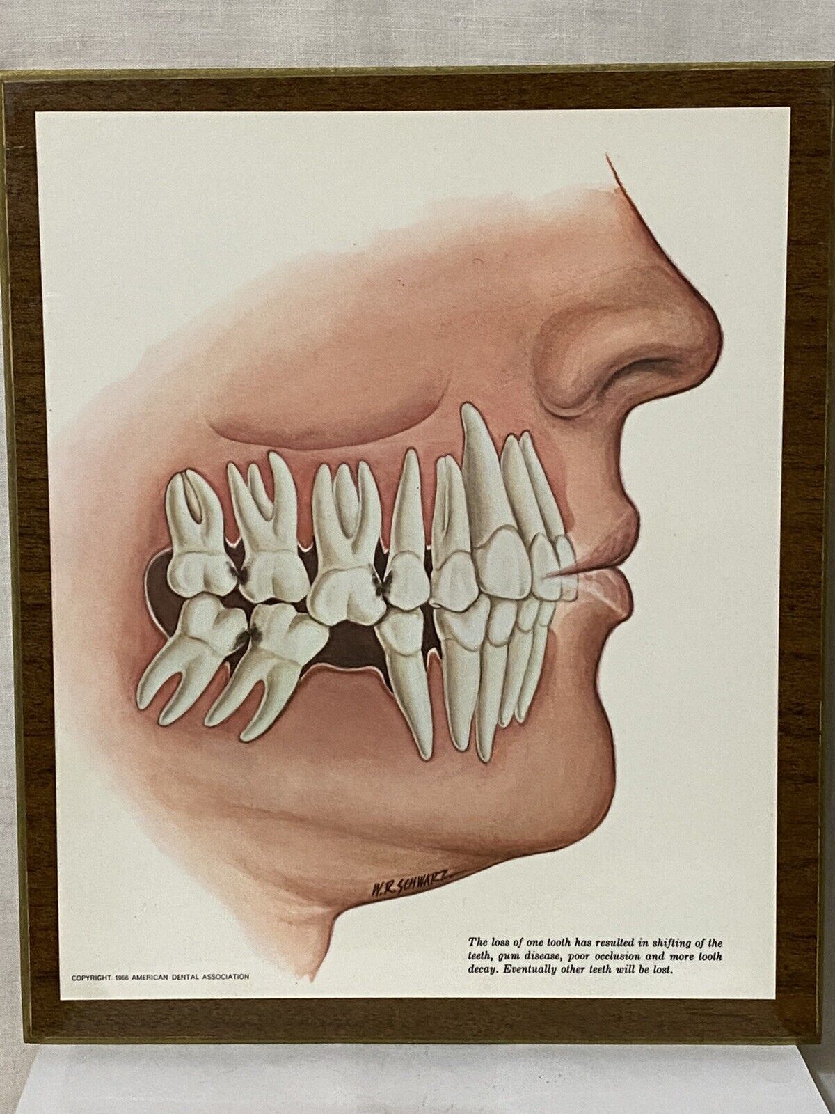 1966 American Dental Association Denat Wall Plaque Shifting Of Teeth Tooth Decay